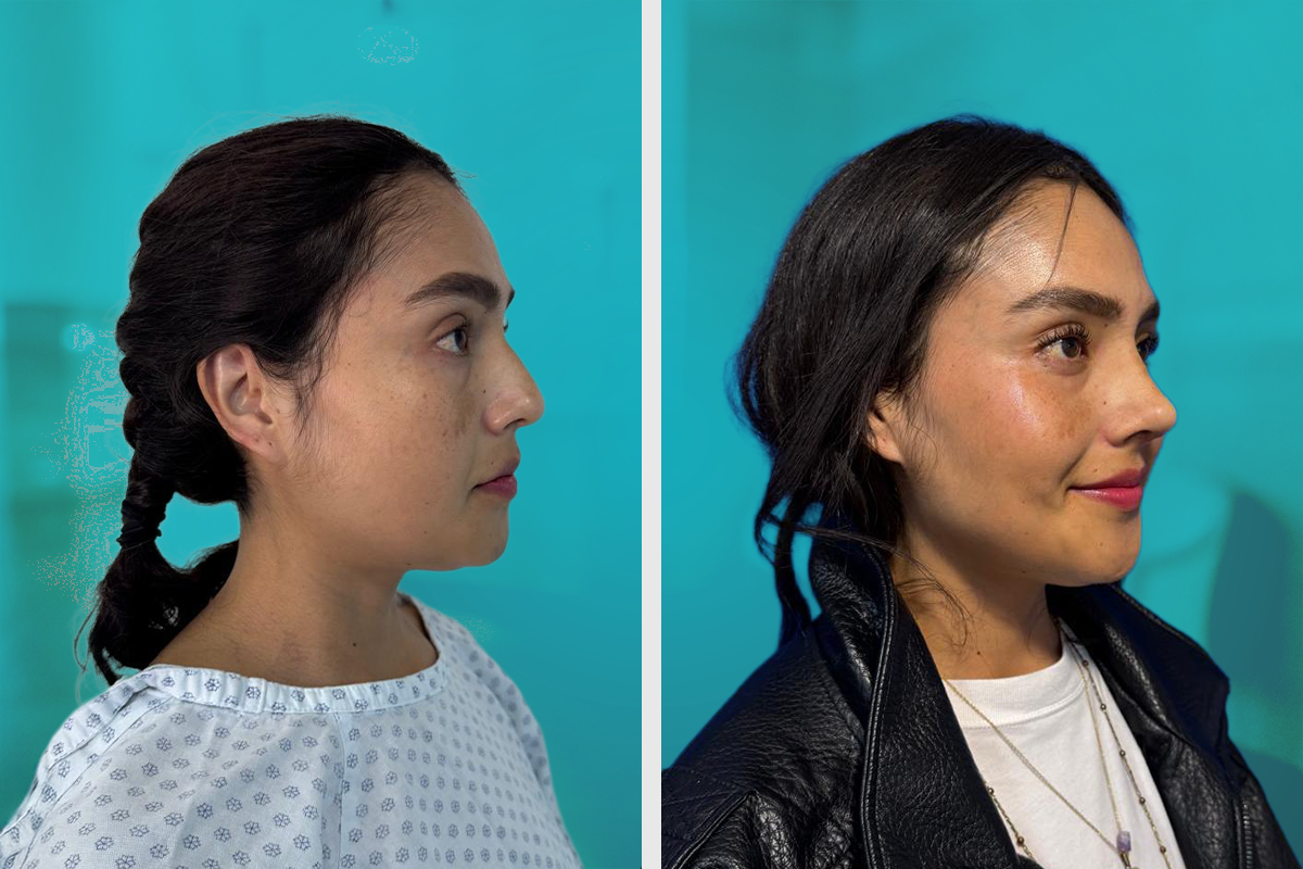 Lifting Facial Resultado